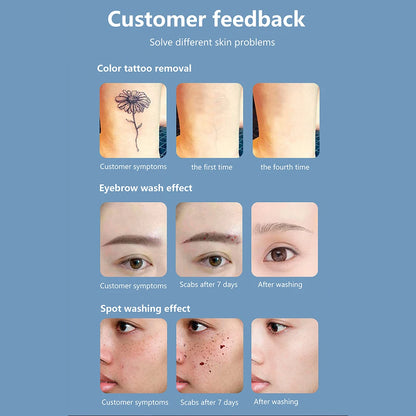 Q-Switch ND YAG Laser Machine – Tattoo & Eyebrow Removal, Mole & Freckle Whitening (532nm 755nm 1064nm)