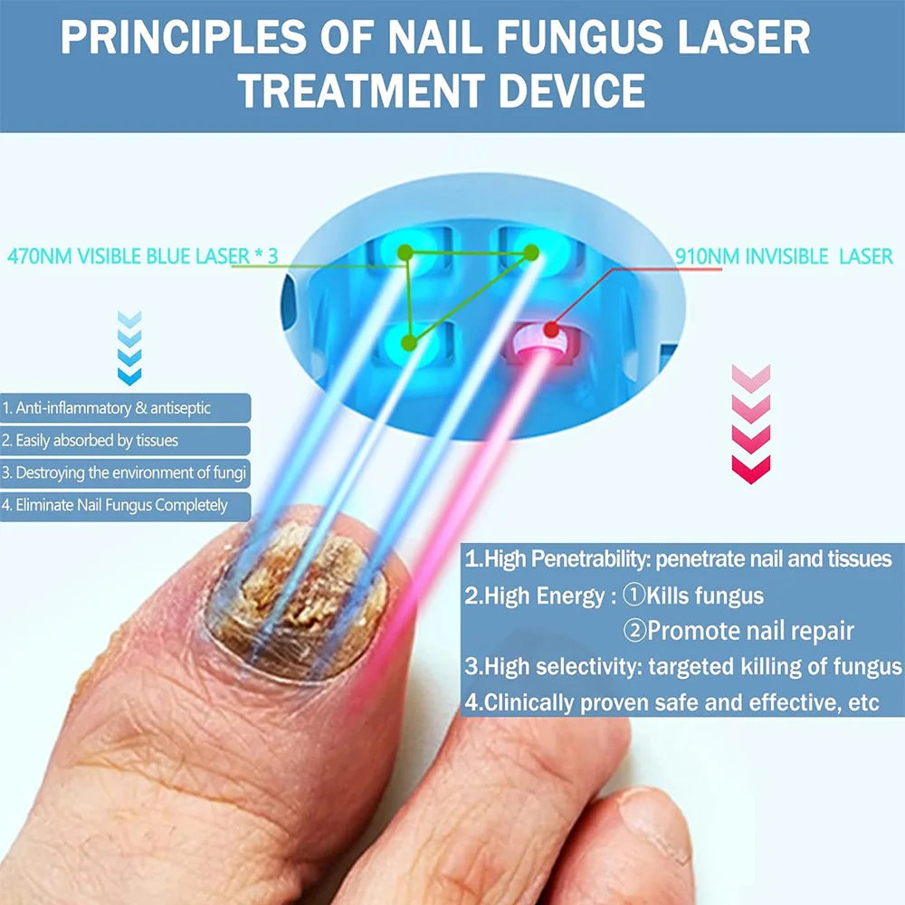 Nail Fungus Treatment Tools – Effective Anti-Fungal Equipment for Toenail & Nail Infection Removal