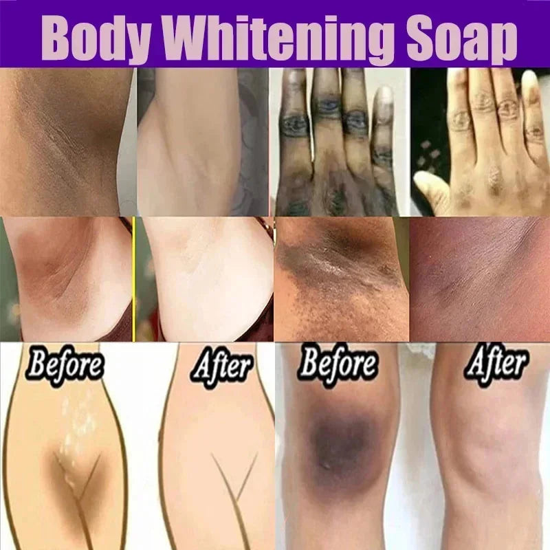 Body Whitening Soap – Underarm & Knee Bleaching, Dark Spot Removal, Chicken Skin Treatment, Dead Skin Exfoliating & Moisturizing