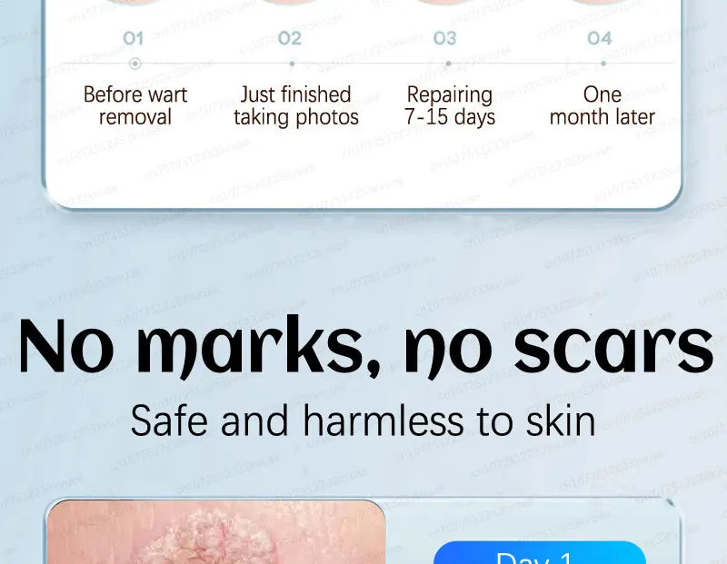 Safe Skin-Friendly Wart Removal Methods – Gentle Solutions for Effective Wart Treatment
