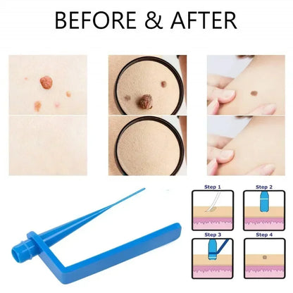 Skin Care Rubber Bands & Skin Tag Remover Kit — Mole & Wart Removal Tool for Face Care, Green Beauty & Health