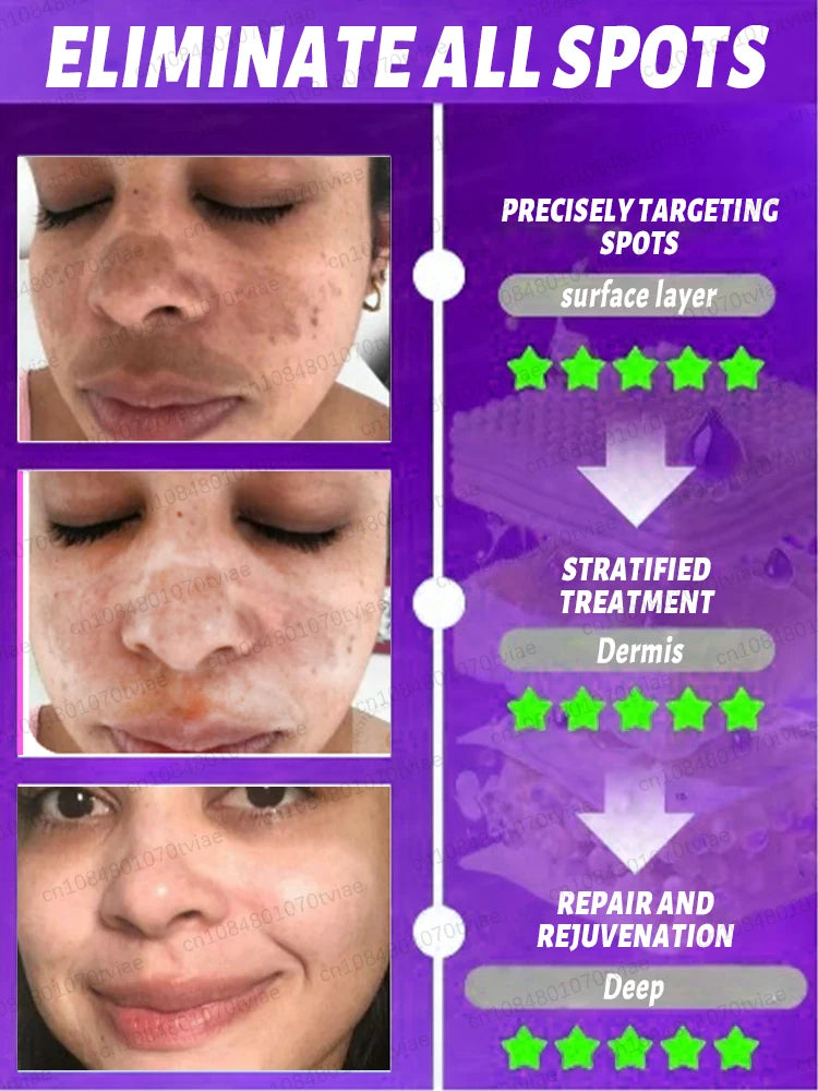 Freckle & Dark Spot Removal Treatment – Fade Chloasma, Age Spots, Acne Marks & Sun Spots