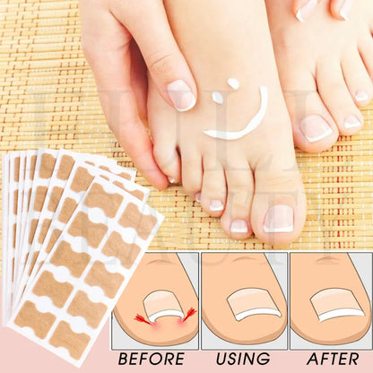 Ingrown Nail Correction Stickers - 40/100/200pcs Toenail Corrector Patches for Paronychia Treatment and Pedicure Recovery