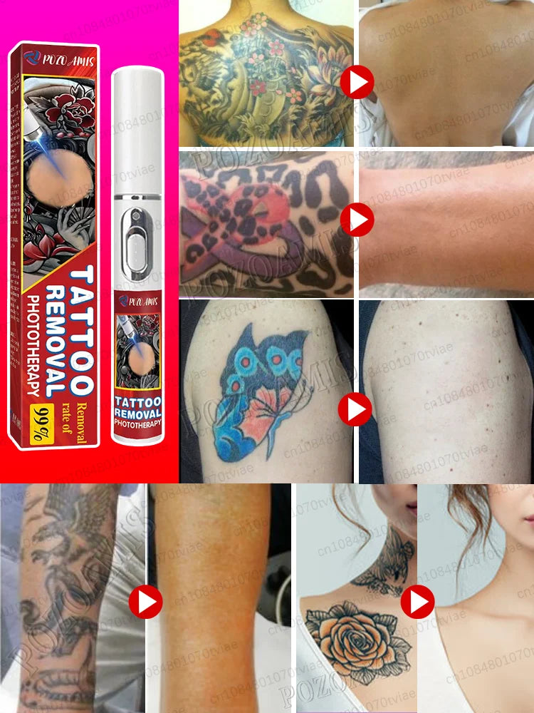 Blue Light Tattoo Removal Pen – Unisex, Suitable for All Ages, Free Shipping