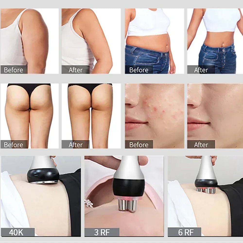 40K Ultrasonic Cavitation Machine – Body Slimming & Facial Lifting RF Beauty Massager for Weight Loss