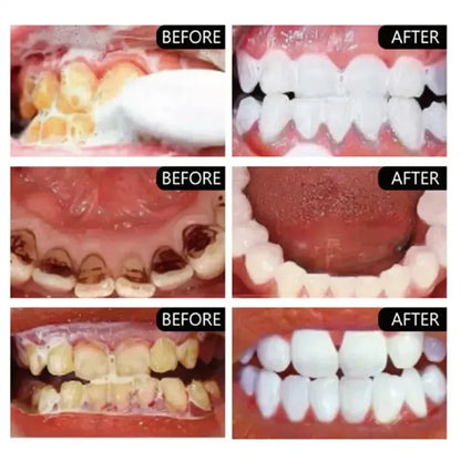 5 Day Teeth Whitening Powder – Removes Plaque & Stains, Deep Cleaning, Fresh Breath & Oral Hygiene Care