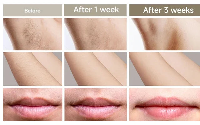 Body Bikini IPL Hair Removal Device — 999,999 Flashes Permanent Painless Laser Epilator for Women, Home Use