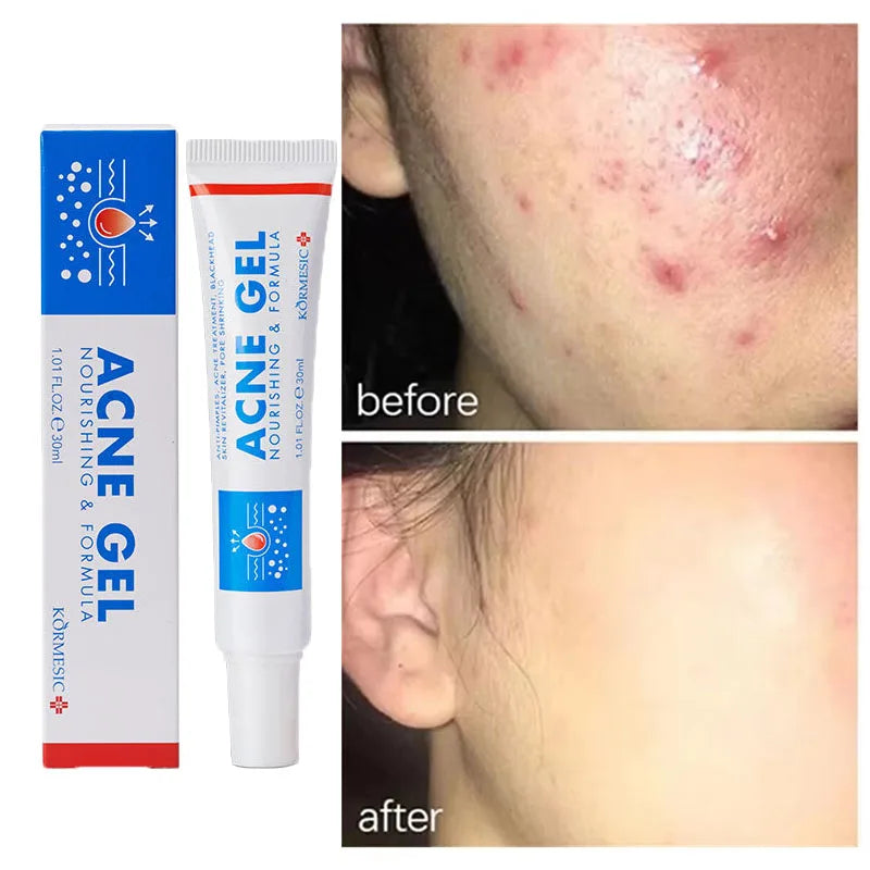 Effective Acne Removal Cream – Anti-Acne Gel for Redness, Pimples, Deep Pore Cleaning & Oil Control Skin Care