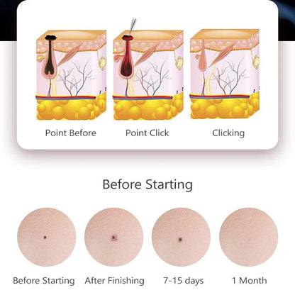 50/100pcs Sterile Surgical Needles for Mini Mole Removal Pen – Spot, Freckle & Plasma Point Beauty Accessories
