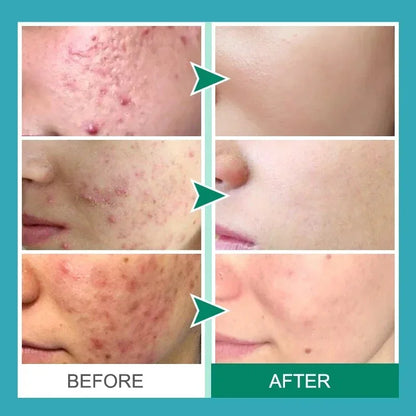Effective Acne Removal Cream 30g – Anti-Acne Gel for Redness, Pimples, Deep Pore Cleaning & Oil Control Skin Care