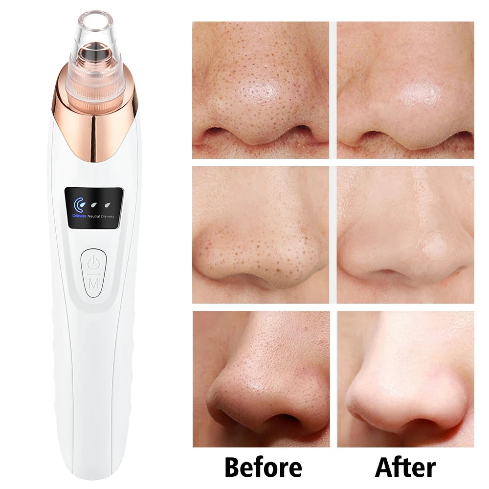 3-Mode Blackhead Remover Vacuum – Facial Pore Cleaner & Dead Skin Removal Beauty Tool