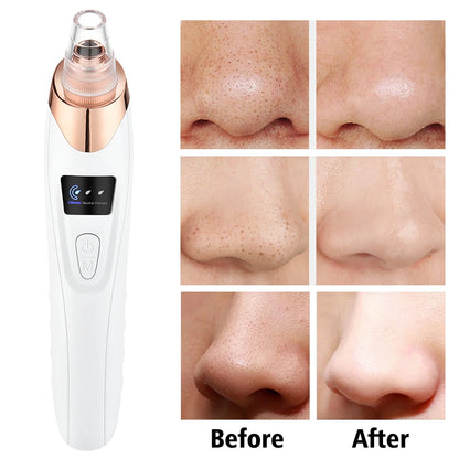 3-Mode Blackhead Remover Vacuum – Facial Pore Cleaner & Dead Skin Removal Beauty Tool
