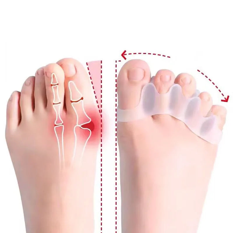 2Pc Silicone Toe Separator — Foot & Toe Spreader for Hallux Valgus, Bunion Correction & Toe Straightening