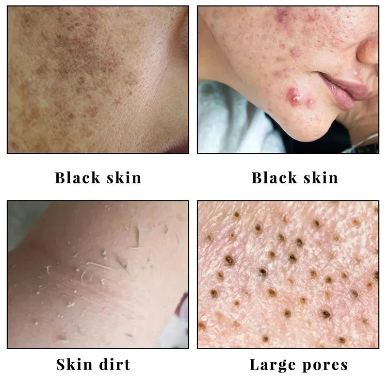 Body Whitening Soap – Underarm & Knee Bleaching, Dark Spot Removal, Chicken Skin Treatment, Dead Skin Exfoliating & Moisturizing