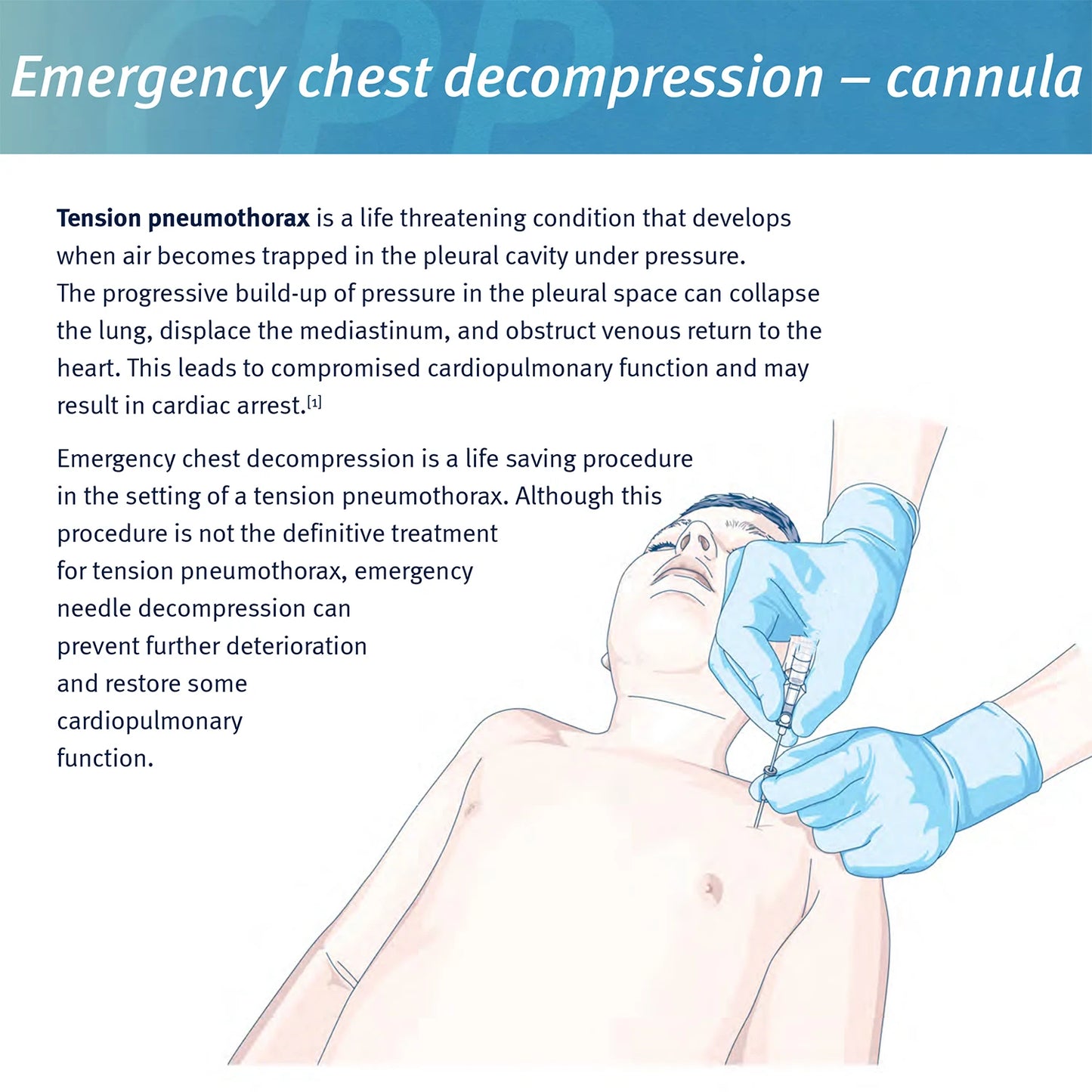 Sanke Rescue Pneumothorax Needle - Trauma Medical Chest Catheter for Decompression - Essential EDC First Aid Kit Component