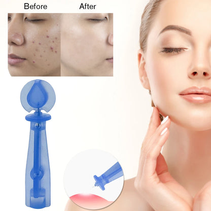 50/100PCS Blackhead Remover Acne Needle Tool - Disposable Skin Care Tools for Acne & Fat Grain Removal