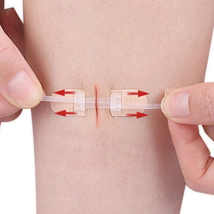 Zipper Wound Closure Device - Suture-Free Laceration Closure Strips for First Aid and Emergency Wound Care