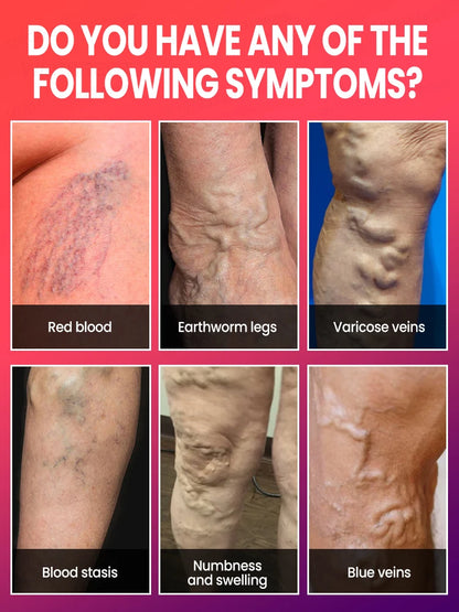 Medical-Grade Laser Treatment for Varicose & Spider Veins – Painless Leg Vein Therapy Equipment