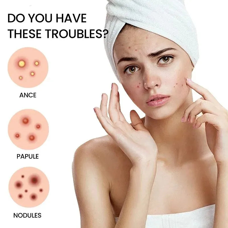 Acne Patch for Facial Skin Care - Fade Blemishes & Pimple Marks - Cover & Repair Acne Blemishes