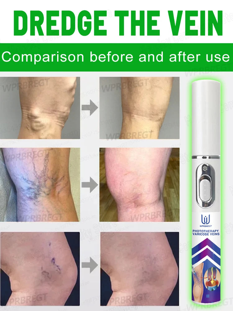 Varicose Vein & Spider Leg Pain Relief Treatment — Painless Care for Vasculitis & Phlebitis
