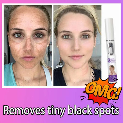 Freckle & Dark Spot Removal Treatment – Fade Chloasma, Age Spots, Acne Marks & Sun Spots