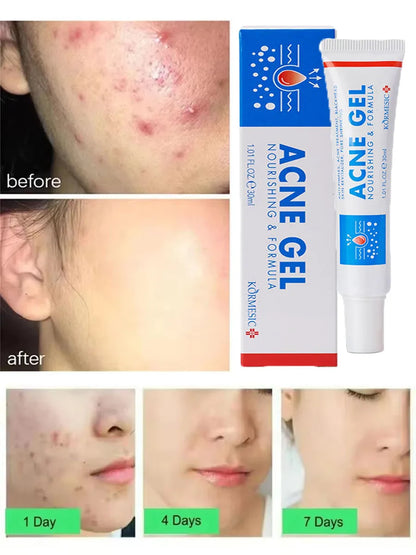 Effective Acne Removal Cream – Anti-Acne Gel for Redness, Pimples, Deep Pore Cleaning & Oil Control Skin Care