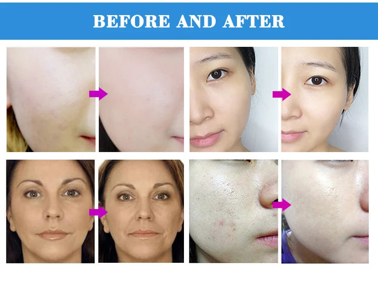 Professional Diamond Microdermabrasion Machine — Facial Exfoliation with Water Spray & 65-68cmHg Suction