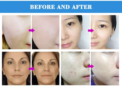 Professional Diamond Microdermabrasion Machine — Facial Exfoliation with Water Spray & 65-68cmHg Suction