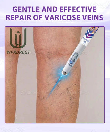 2nd Gen Varicose Vein Laser Therapy Device – Relieves Spider Leg Pain, Treats Vasculitis & Phlebitis