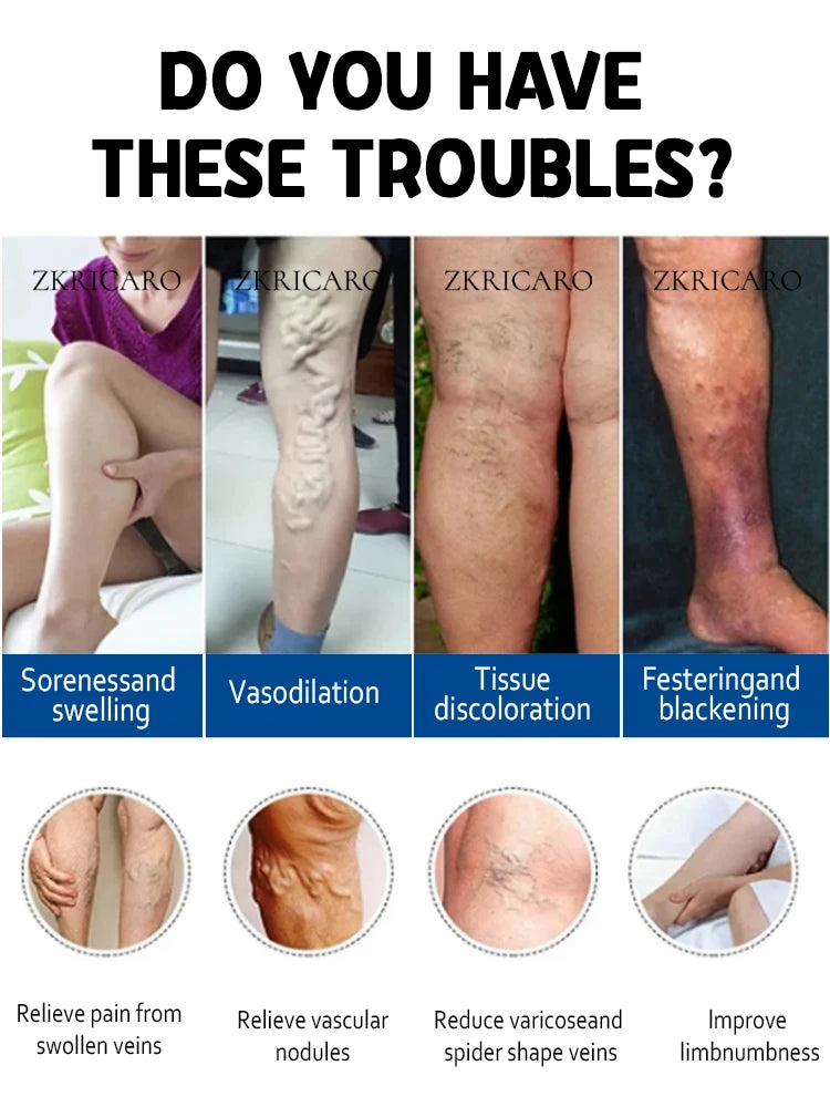 Varicose Vein & Spider Leg Pain Relief Treatment — Painless Care for Vasculitis & Phlebitis