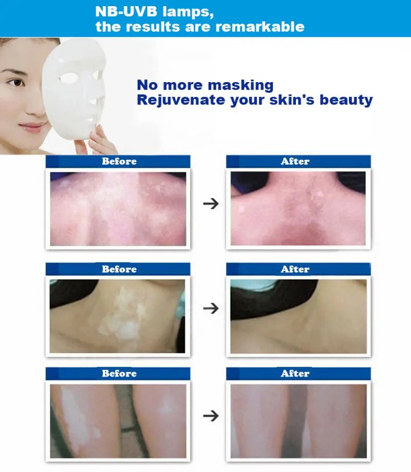 UV 311nm Phototherapy Device – Philips UVB Lamp for Vitiligo, Psoriasis & Skin Treatment