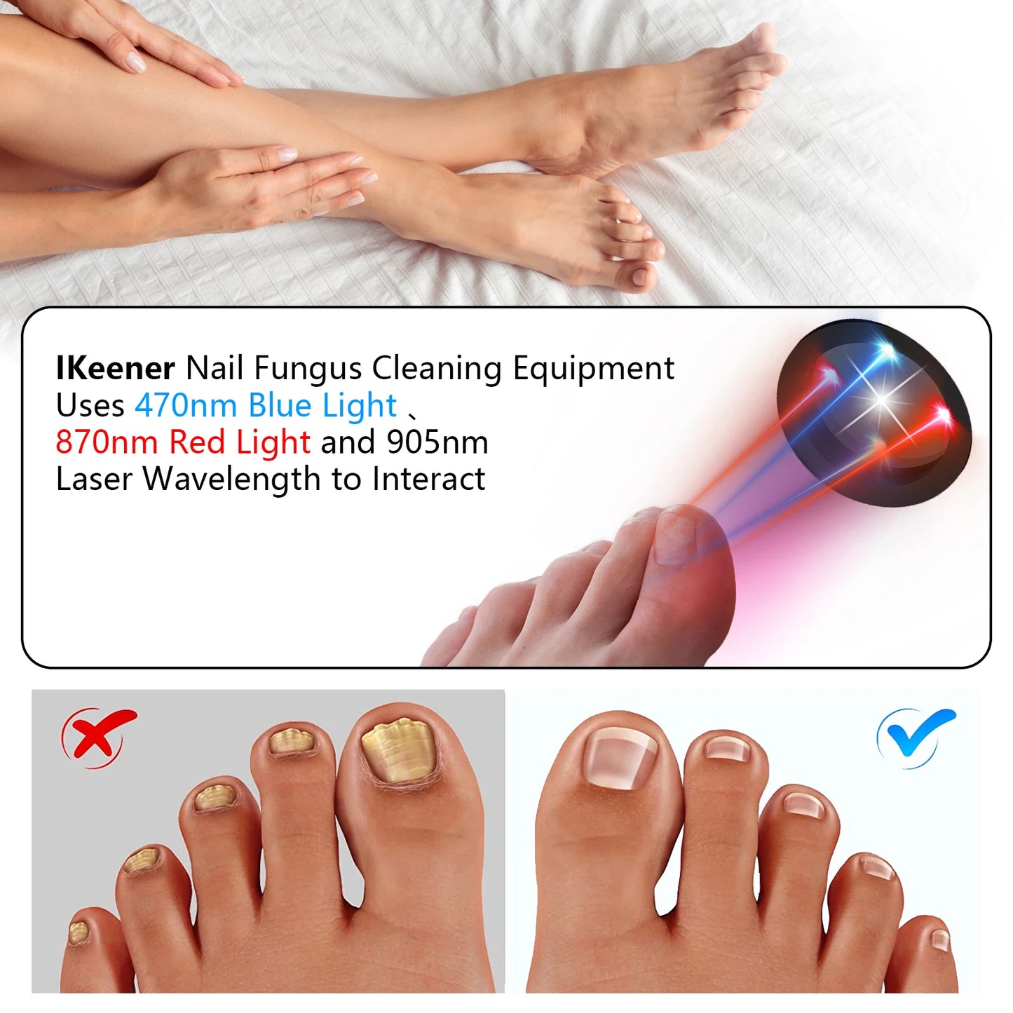 Fast Nail Fungus Repair with Fungal Nail Laser Device - Effective Onychomycosis Treatment